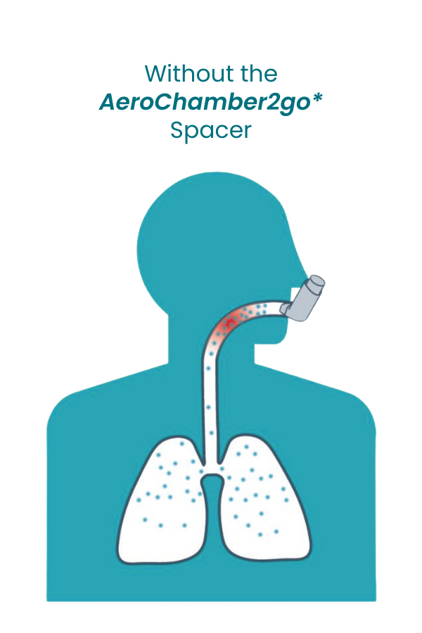 Without the AeroChamber2go spacer: medication depositing in the throat
